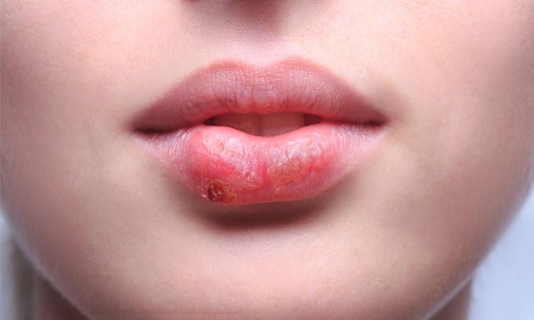 how to get rid of cold sores